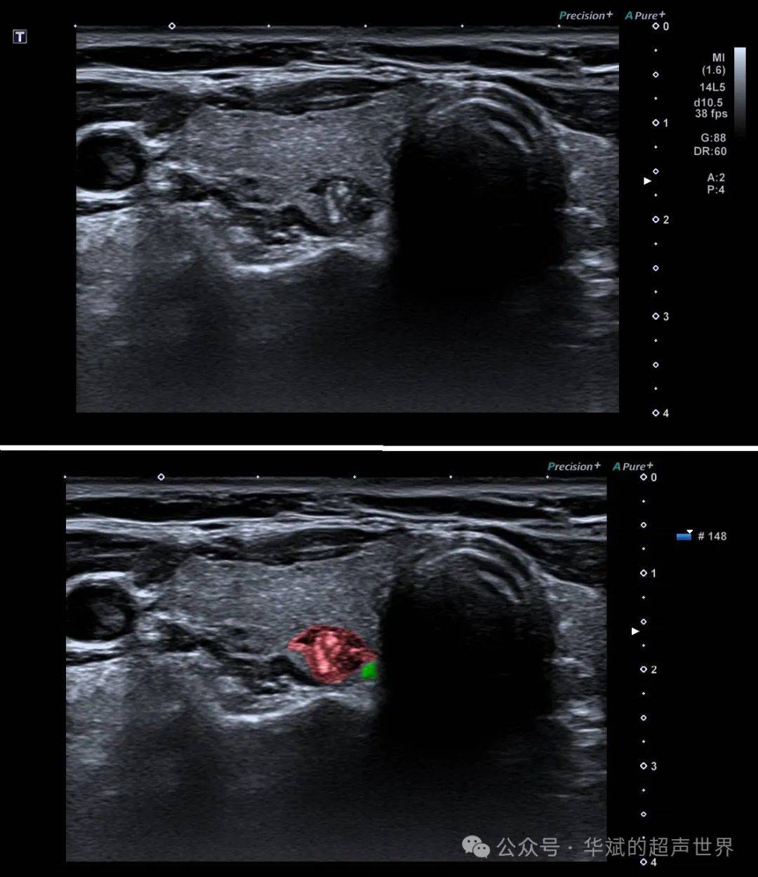 甲状旁腺腺瘤超声图片图片