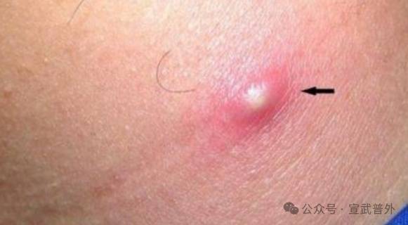 "疖子"虽小,后患无穷