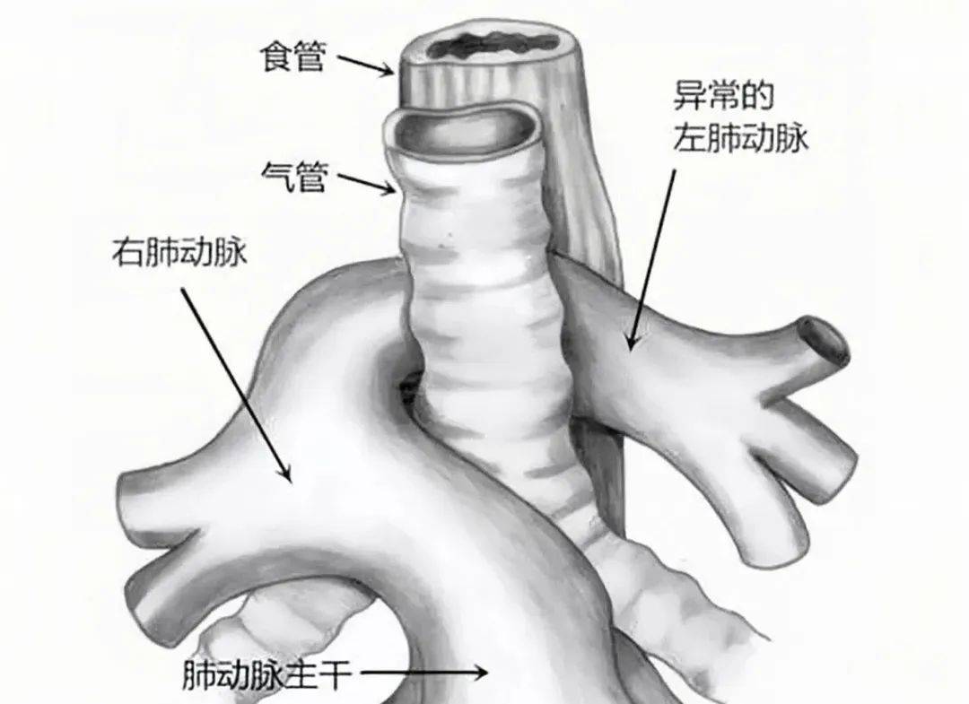 肺动脉吊带合并支气管桥!医生两次手术为患儿拓"生"路