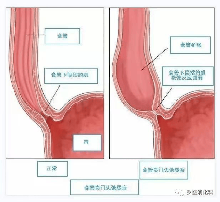 病例分享丨一例贲门失弛缓症患者的麻醉思考_食管_诊断_食物