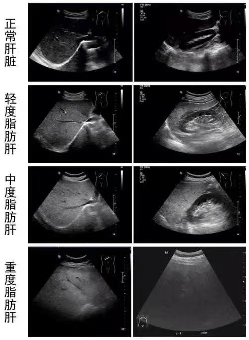 肝脏是个小胖子?——脂肪肝超声可见