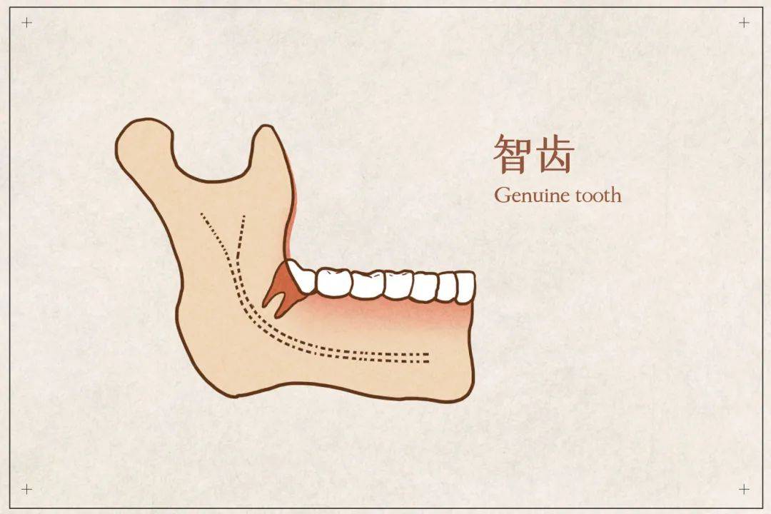 拔智齿全过程图片