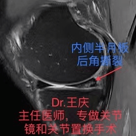 当心半月板损伤!科学预防注意这7点