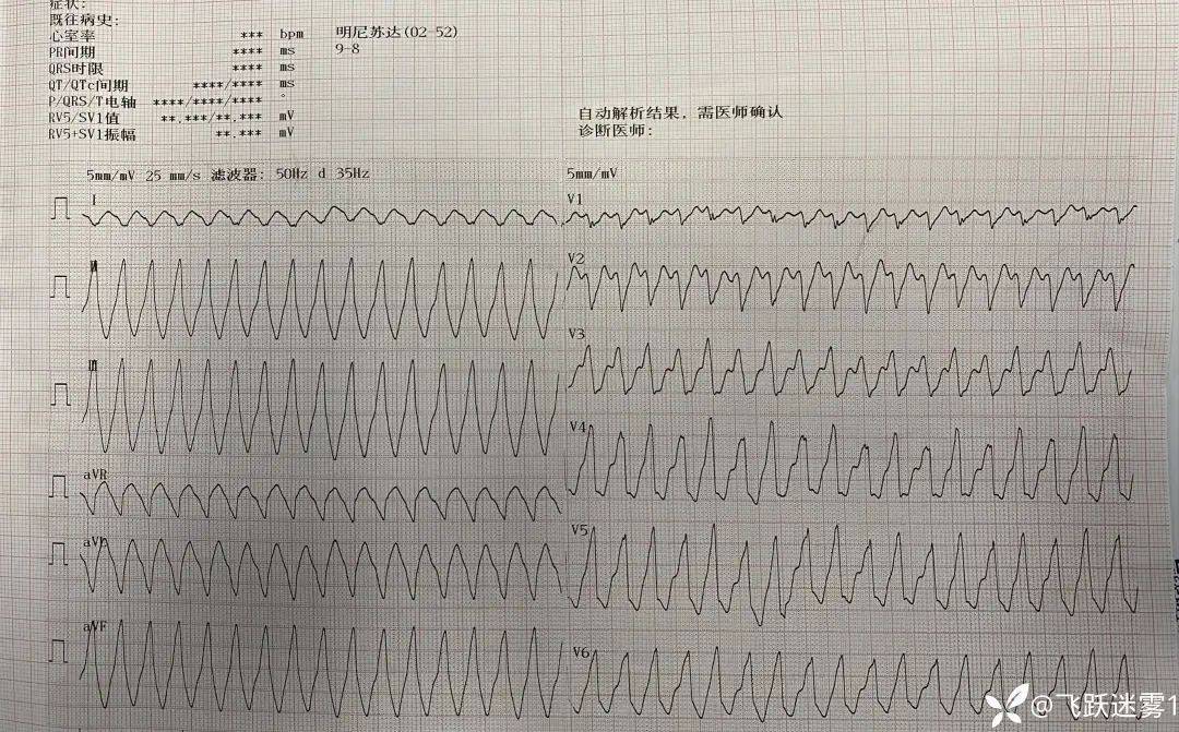 没见过!这张罕见心电图,震惊上万同行,直呼:快喊主任来