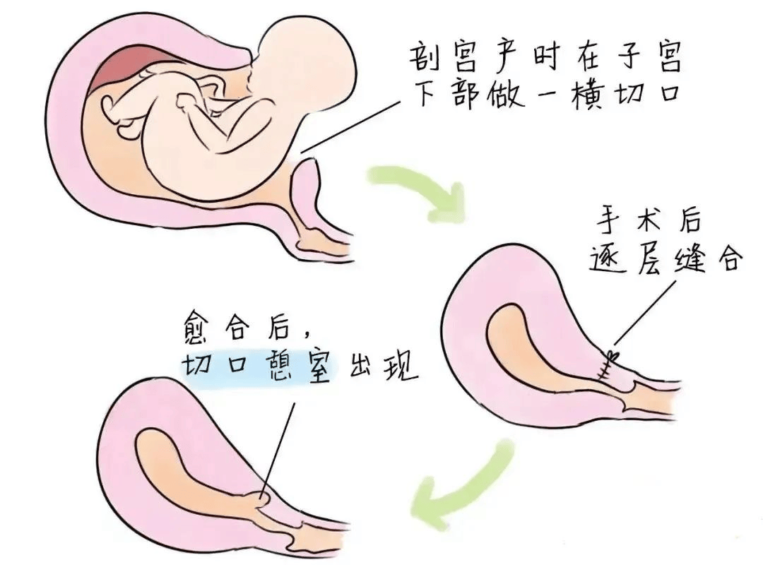 剖宫产术后子宫瘢痕憩室又称为剖宫产术后子宫切口缺损,指剖宫产术后