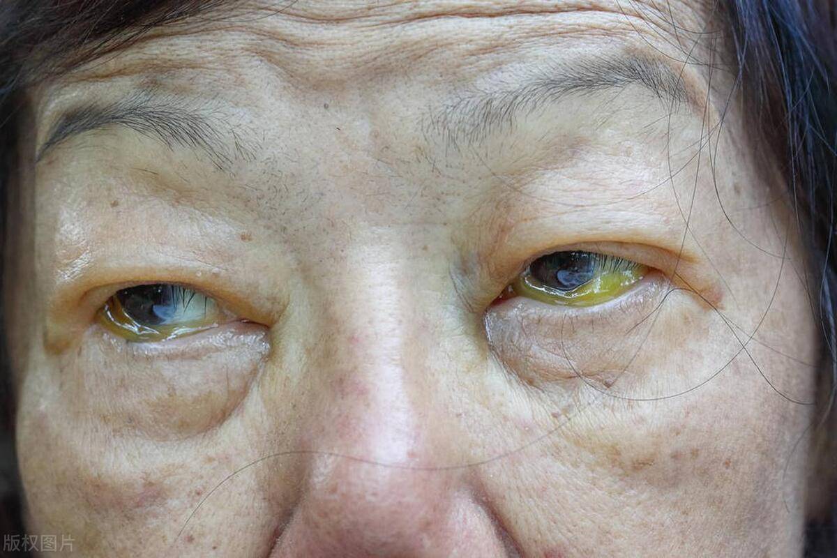 如果有,希望你尽快做个检查,别坐等肝癌_症状_患者_肝功能