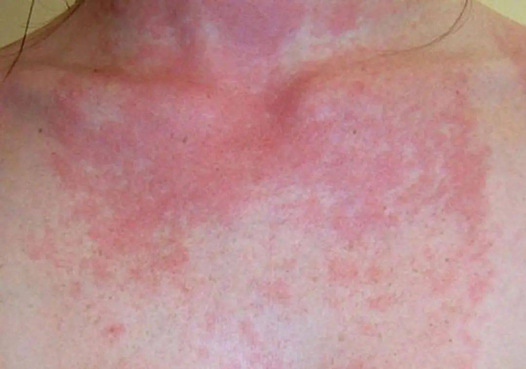 皮肤过敏有哪些常见的护理方法?