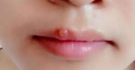 嘴巴起泡是内火,千万别弄破!这样做才能快速消除!