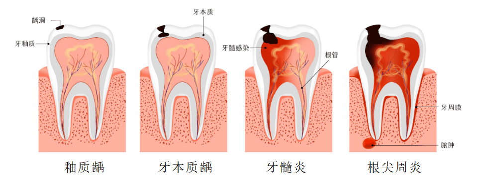 牙本质小管暴露图片