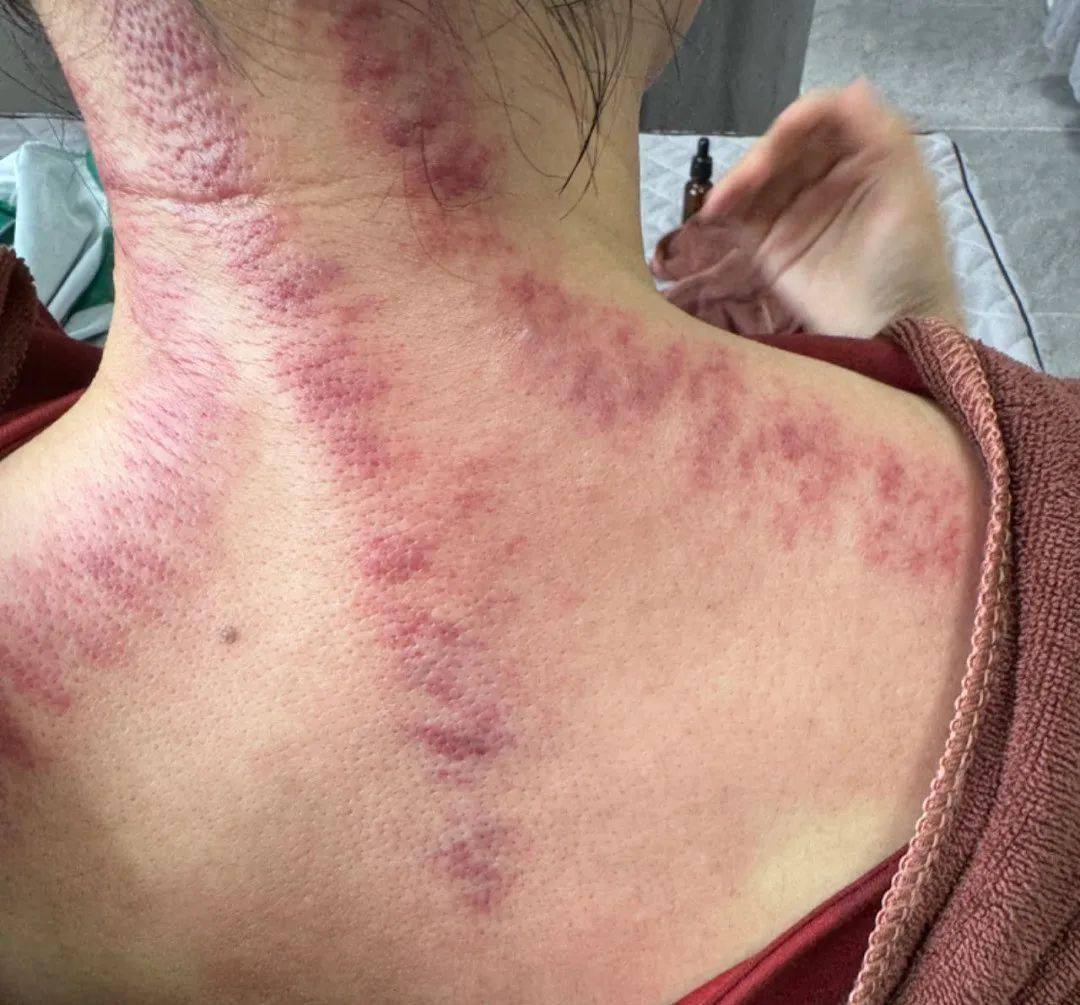 医案:蕲春艾灸学习,意外治好手上严重湿疹(之前惨不忍睹)