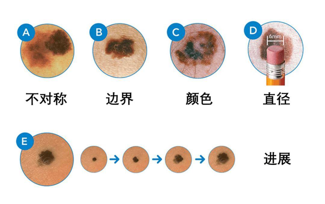 痣的分布图图片