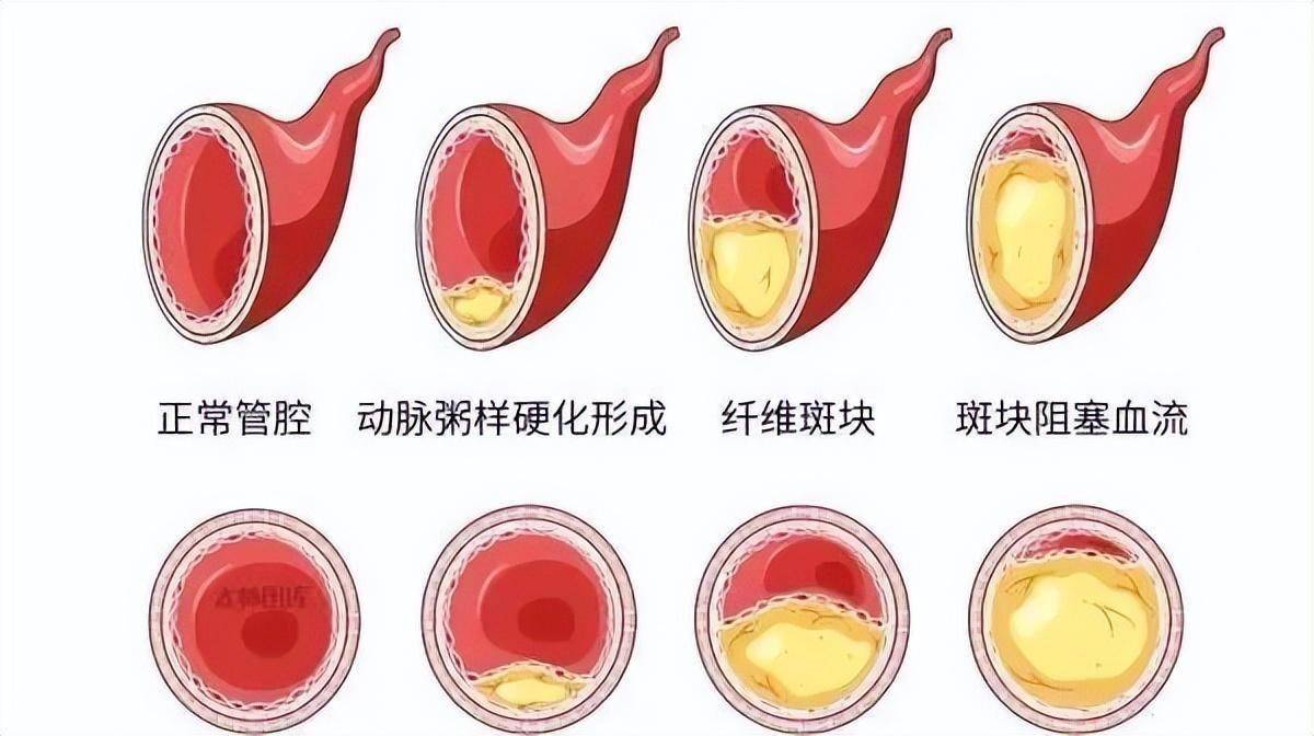 发现颈动脉斑块