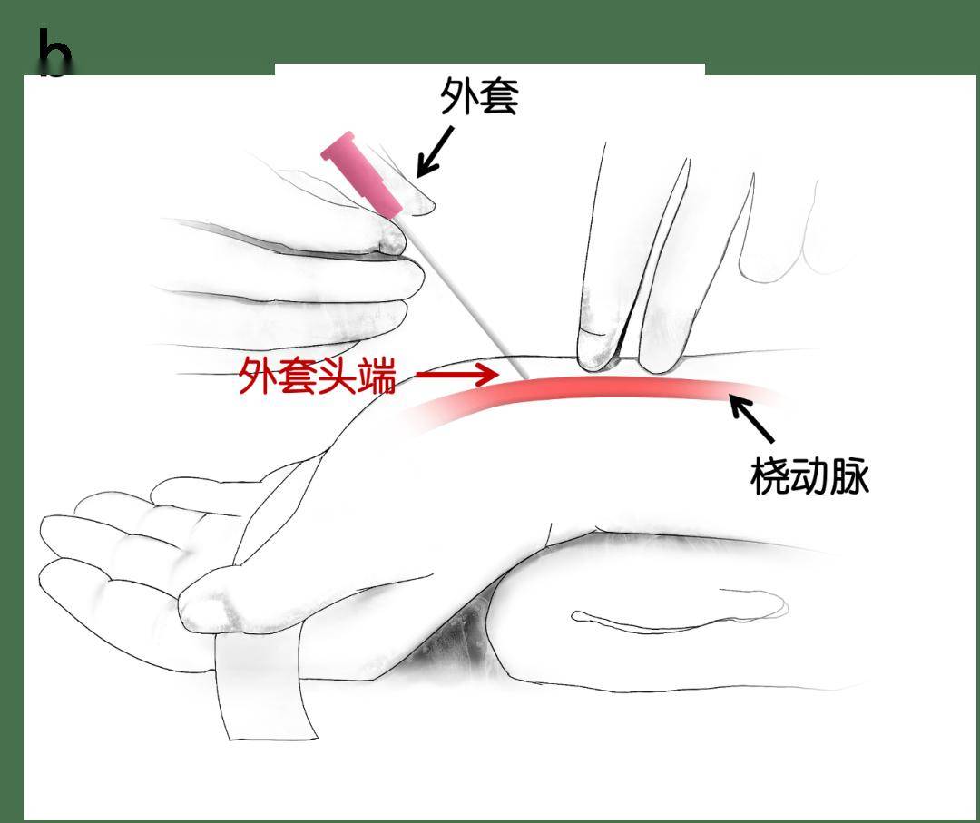 肱动脉采血进针角度图片