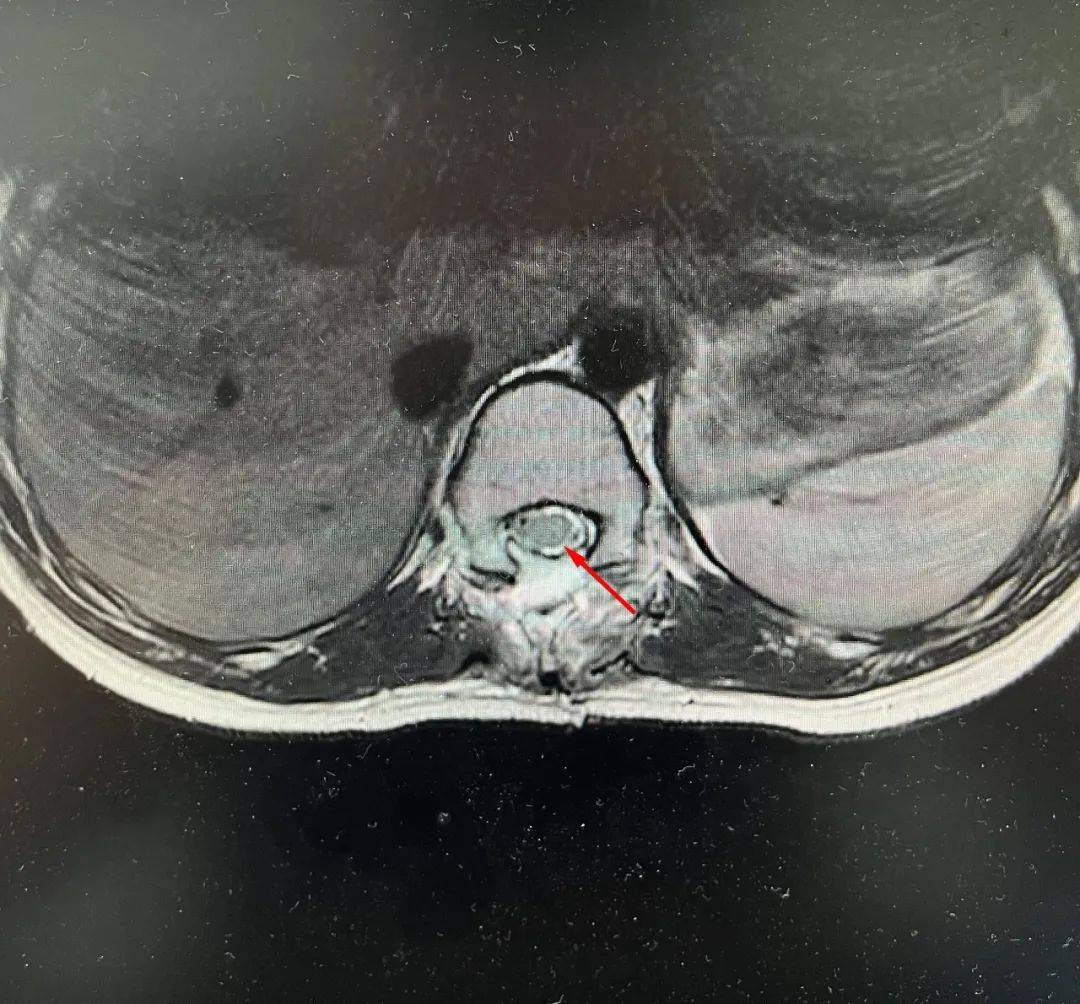 椎管内囊肿图片图片