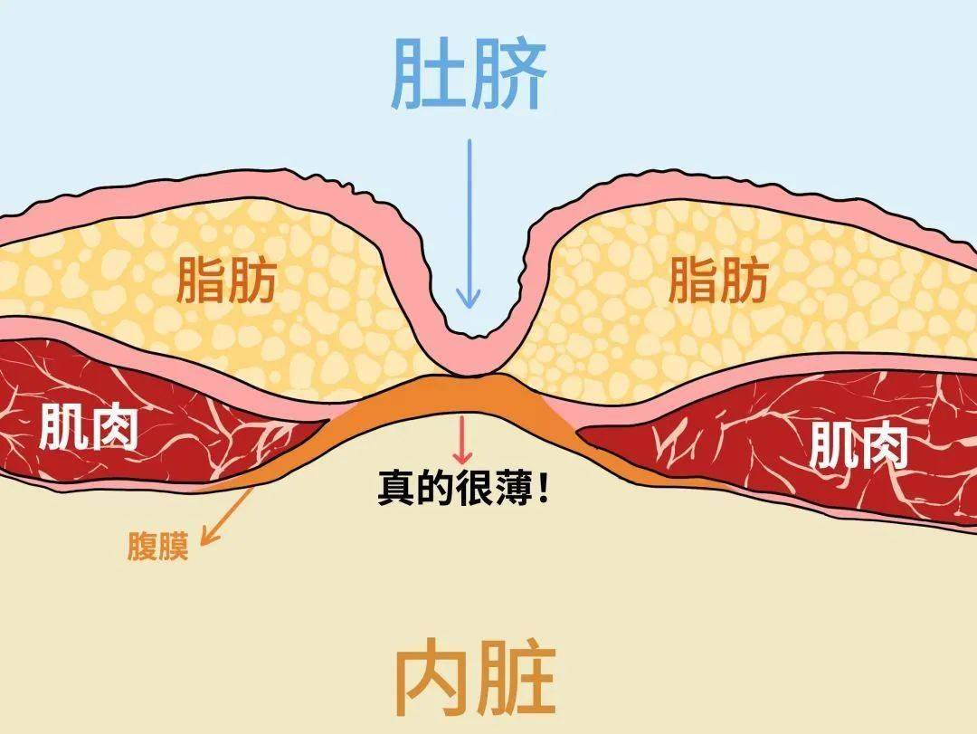 脐正中韧带图片