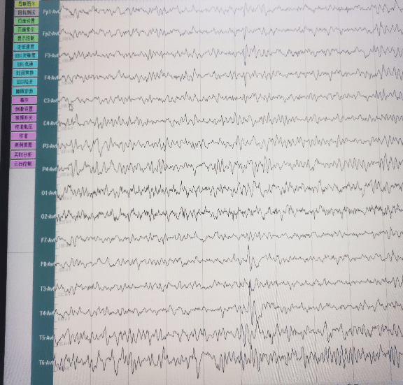 儿童脑电图全脑放电图片