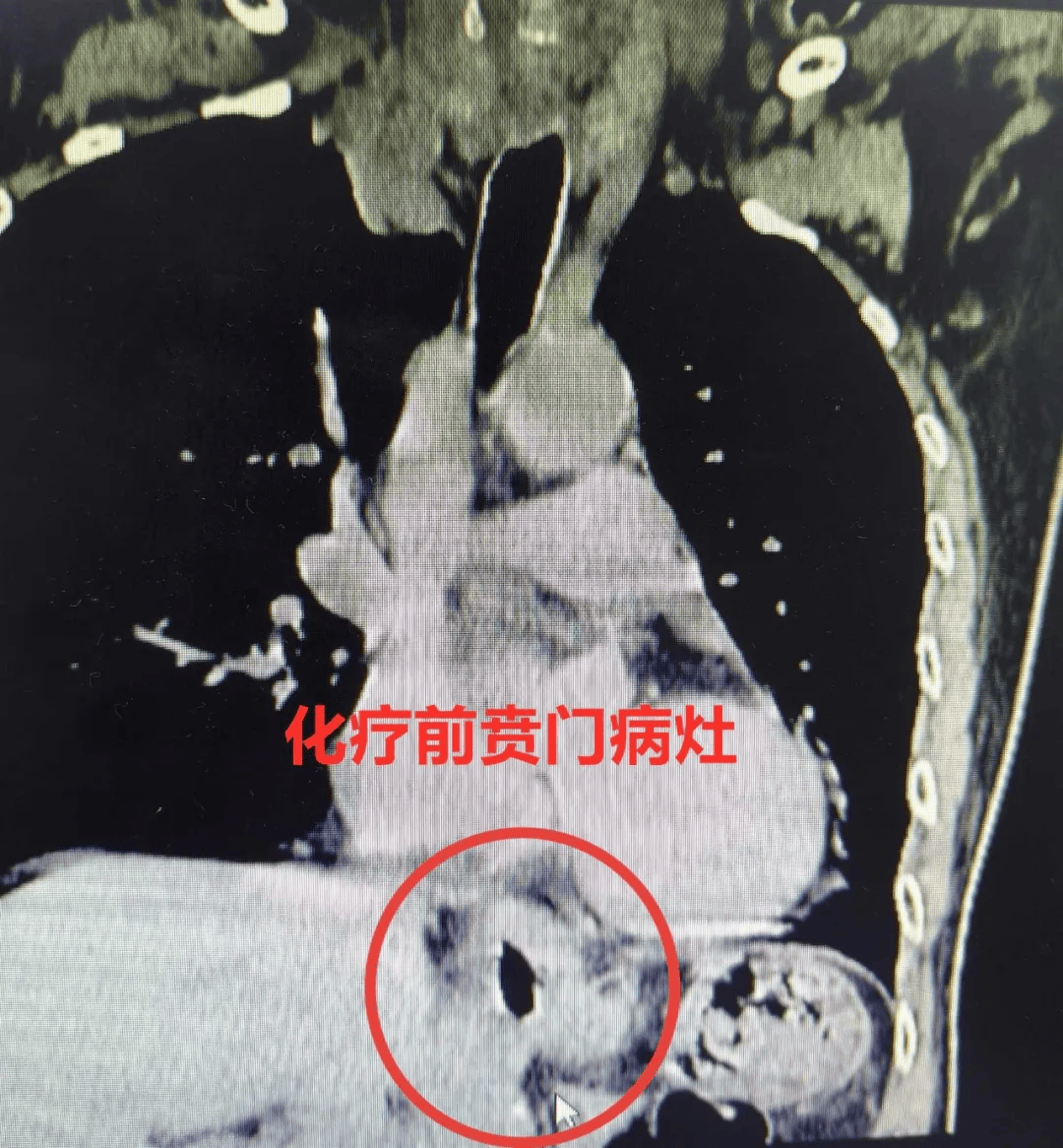 发现食管癌麟,贲门腺癌;为较罕见食管贲门双原发癌,且两个肿瘤距离较