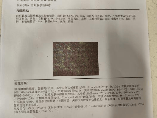 齐河县人民医院成功独立完成首例腹腔镜下前列腺根治性切除术