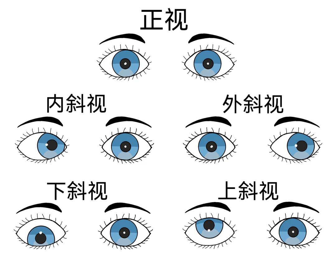 自己斜视测试图 轻微图片