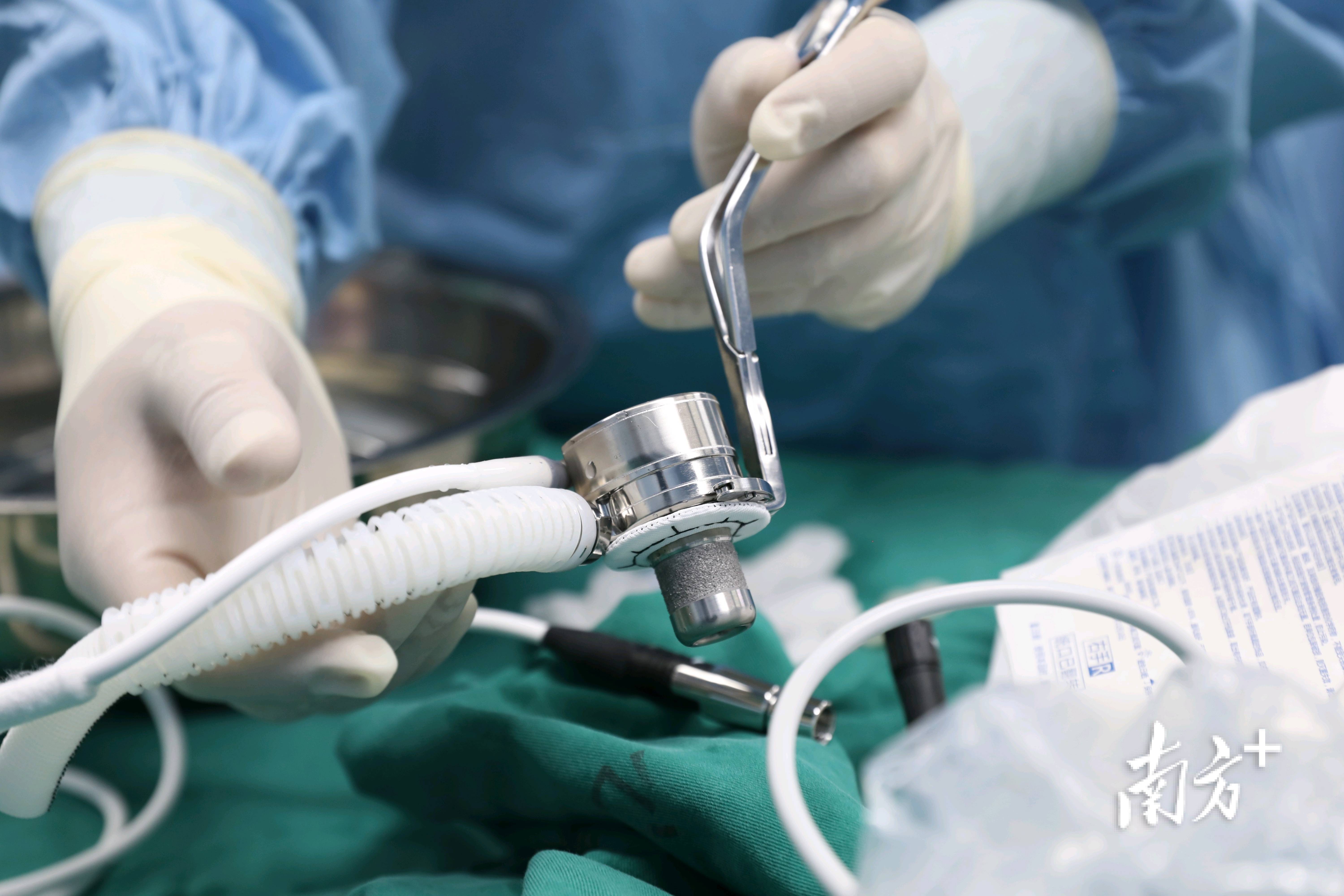 粤东首例人工心脏置入术在汕头成功开展