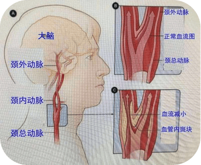 颈动脉狭窄程度图片