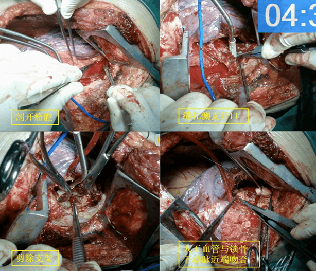 CVC 2024 年度10大案例展播｜畅怡：开放手术治疗支架后巨大锁骨下动脉瘤(图4)