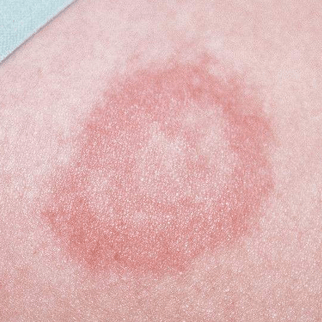 登革热科普系列③丨感染疾病后的症状及就医提醒