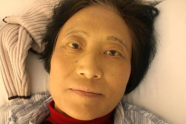胰腺癌早期,不是看痛不痛!忠告:出现4种异常或已患癌,快看看
