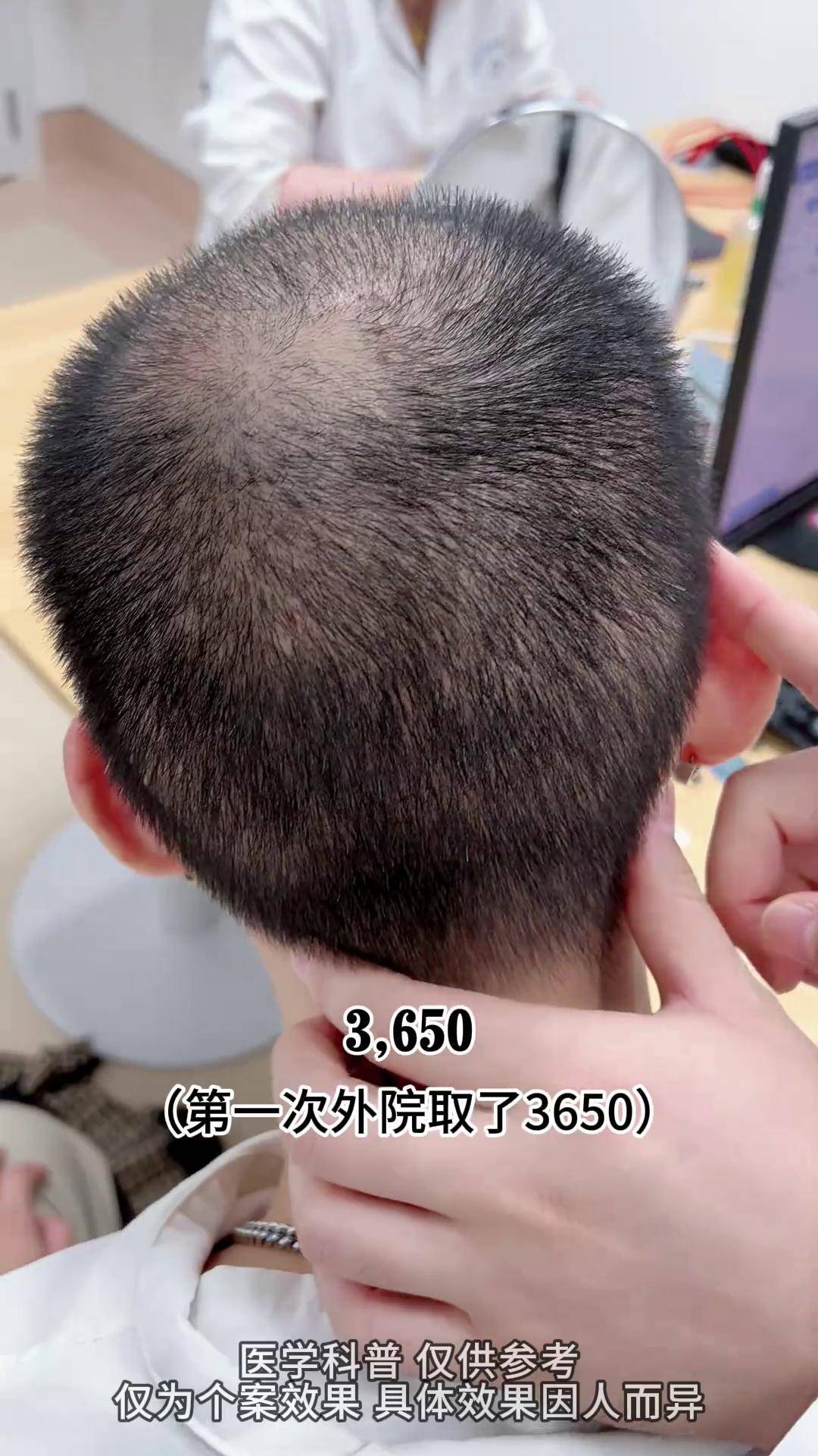 脱发可以补发植发(掉的头发可以用来植发吗)