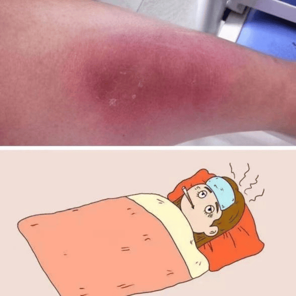 丹毒:一个不容忽视的皮肤感染