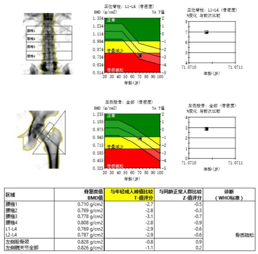 骨密度曲线图图片图片