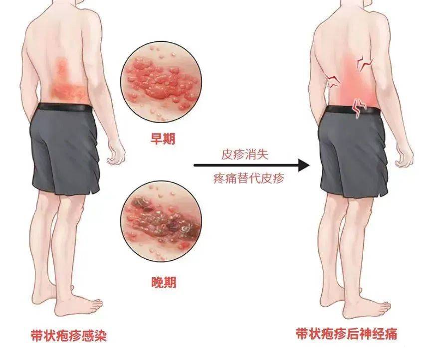 有人拆快递后感染此病毒！“双11”紧急提醒→