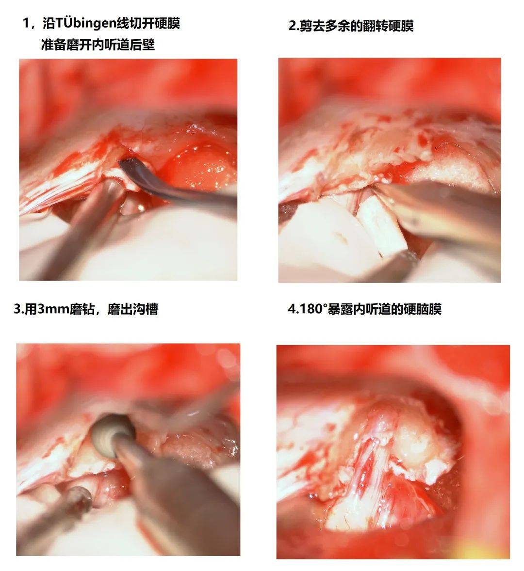 病例夹 张建富副主任医师 面神经后置