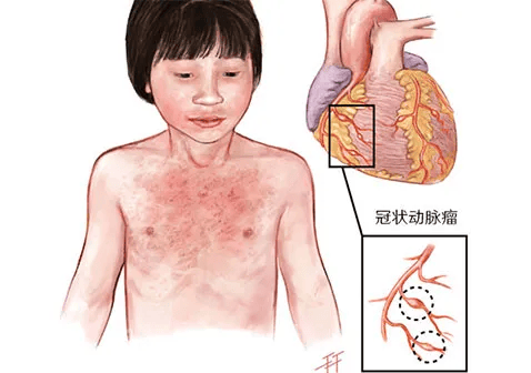 儿童川崎病症状图片