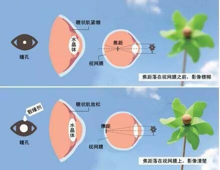怎么知道孩子是不是近视？ 去医院散瞳好吗？_搜狐网