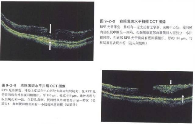 眼底病黄斑裂孔