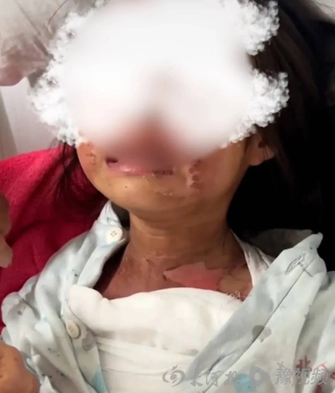 广东被高年级男生泼开水女童已返校,家长称多人被处理 广东被高年级男生泼开水女童已返校,家长称多人被处理