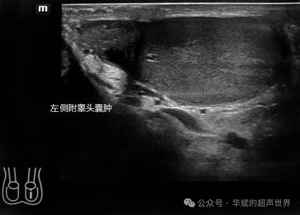 超声问答61附睾头内的强回声斑快闪伪像考虑什么?