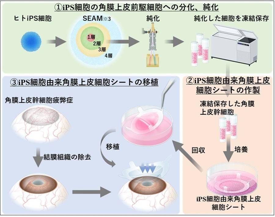 4人得以重见光明：大阪大学首次利用iPS再生组织修复LSCD患者角膜