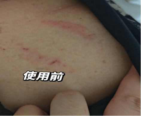 diy 奇招破解电极片过敏困境