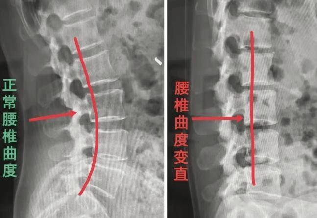 正常人腰椎的弧度图片图片