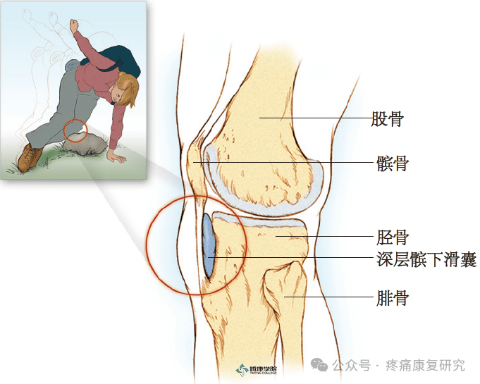 髌前滑囊炎图片