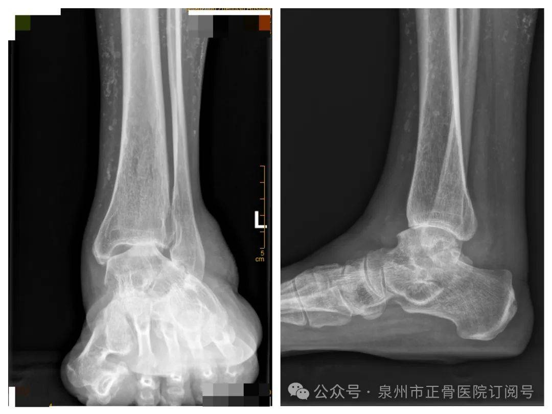 正骨技术3d打印助力精准开展全踝关节置换术