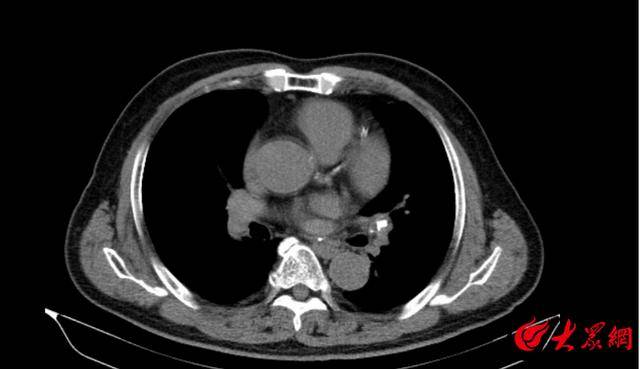 潍坊寿光市综合医院：一段小骨头引发的病症！