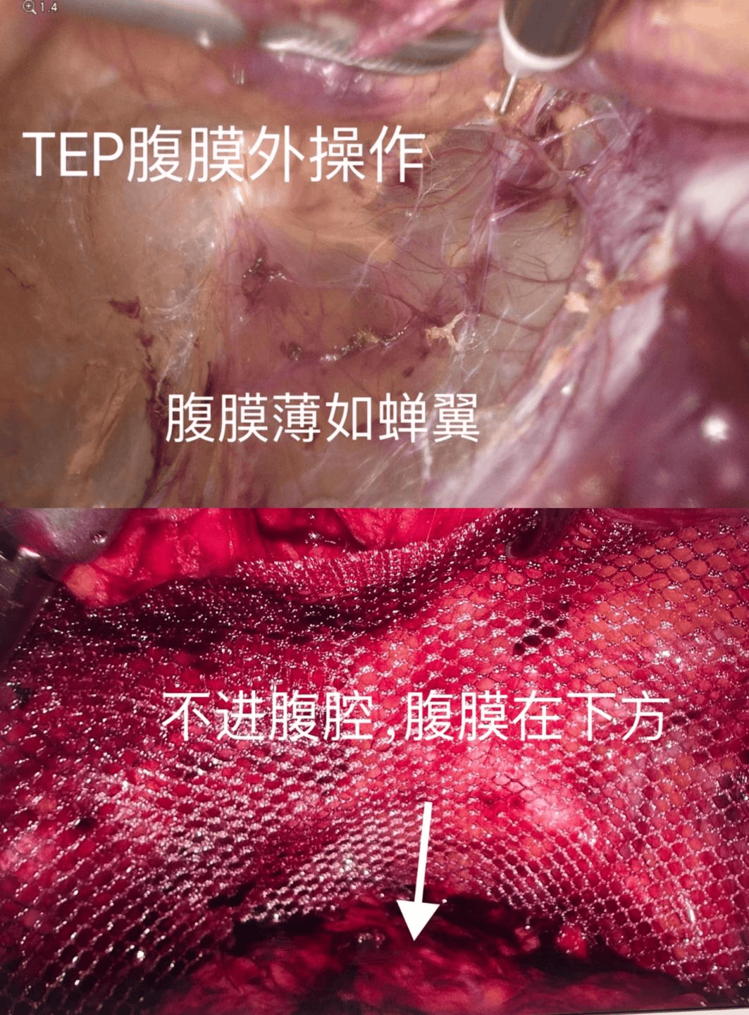 聊聊腹股沟疝_肖鹏_手术_腹腔镜