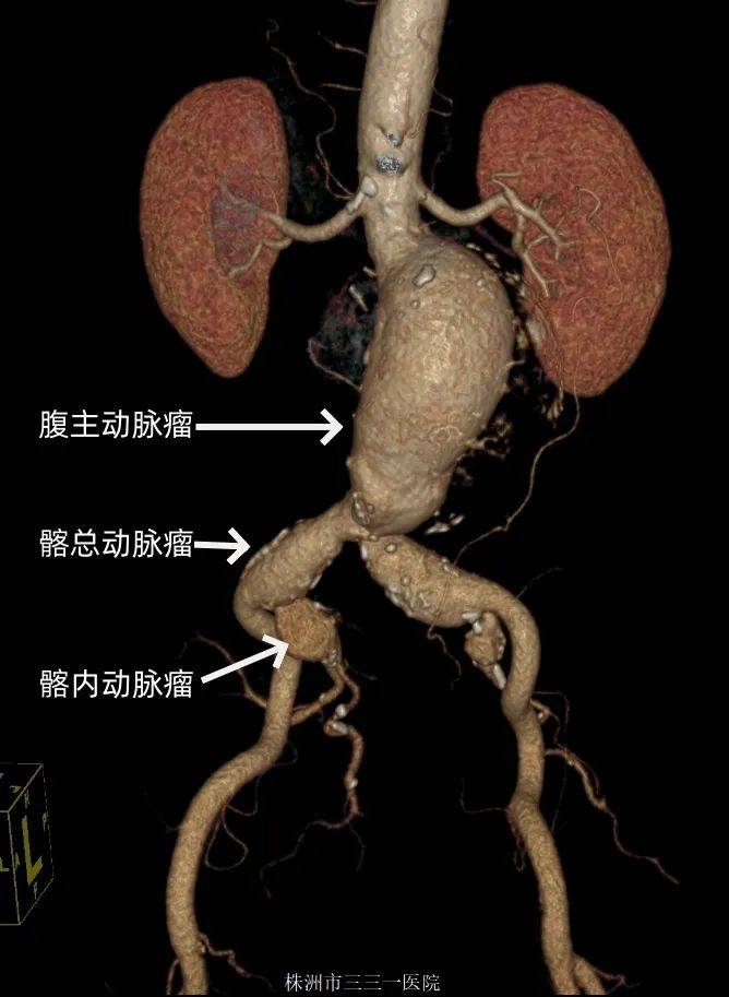 髂内动脉造影图谱图片