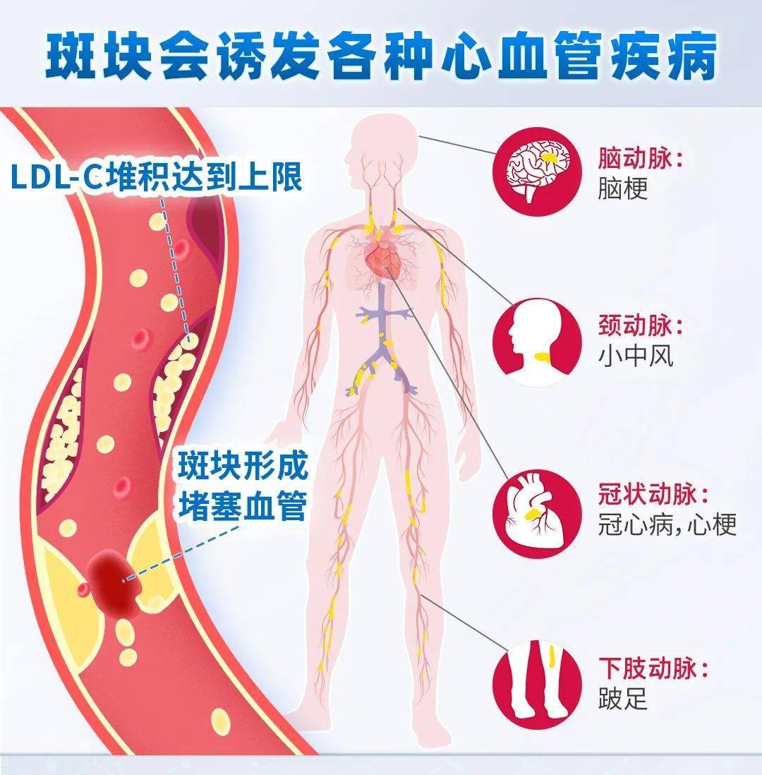 血管硬化年龄对照表图片