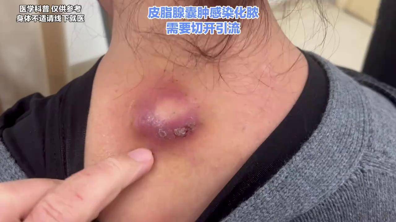 皮脂腺囊肿平时不痛不痒,如果感染化脓了,就可能需要挨一刀