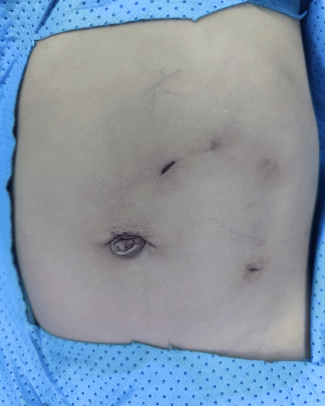 肿瘤切除术后几近无痕,胃肠外科团队为浅表肿瘤宝宝带来福音_手术