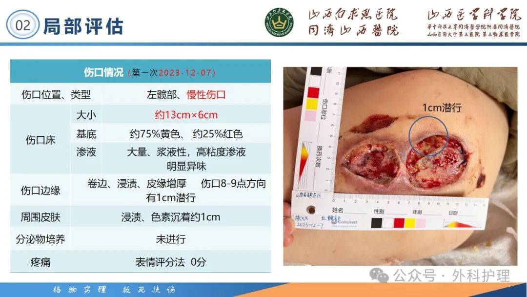 【ppt】一例3期压力性损伤患者的居家护理体会